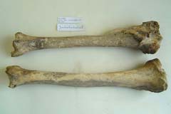Lower leg bones (tibiae) from the same individual. The top one shows a healed fracture, leaving it shorter than the other one.